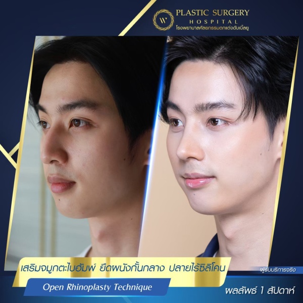 เสริมจมูก