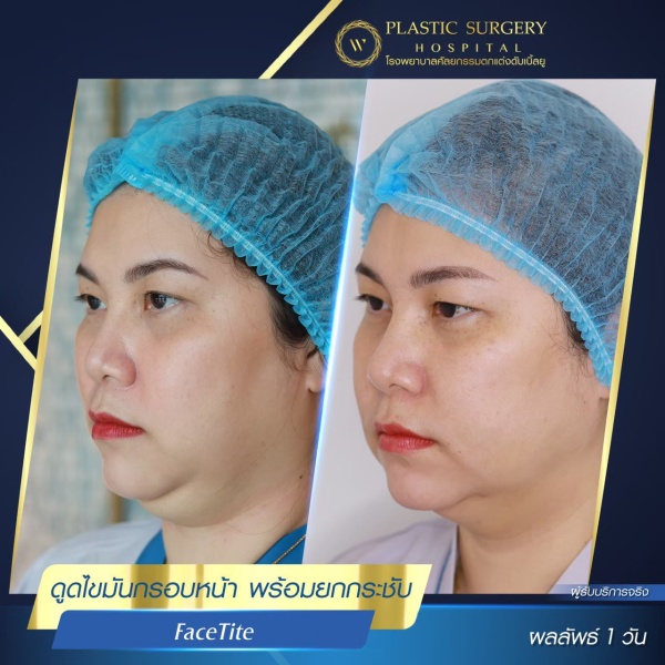 脸部和颈部的提升和抽脂