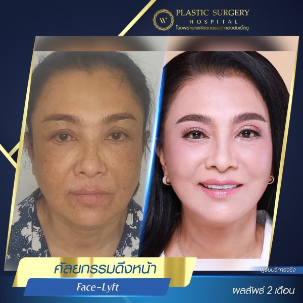 ดึงหน้า