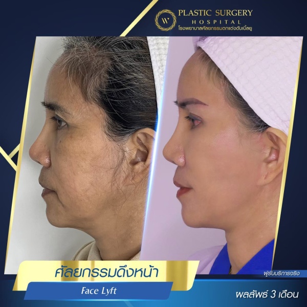 ดึงหน้า