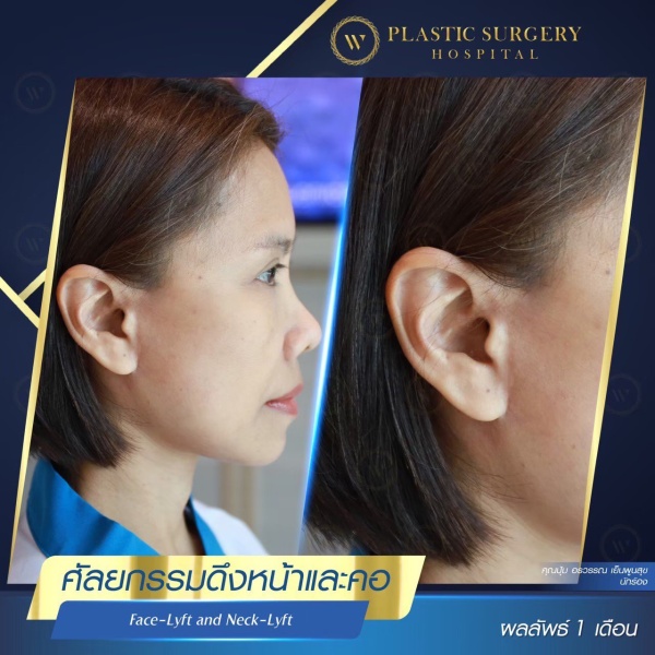 ดึงหน้า