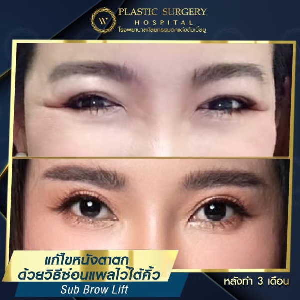 หนังตา/หางตาบนตก