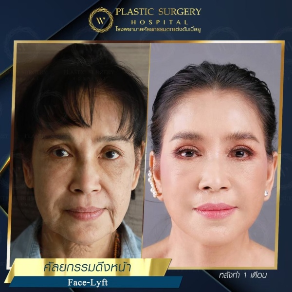 ดึงหน้า