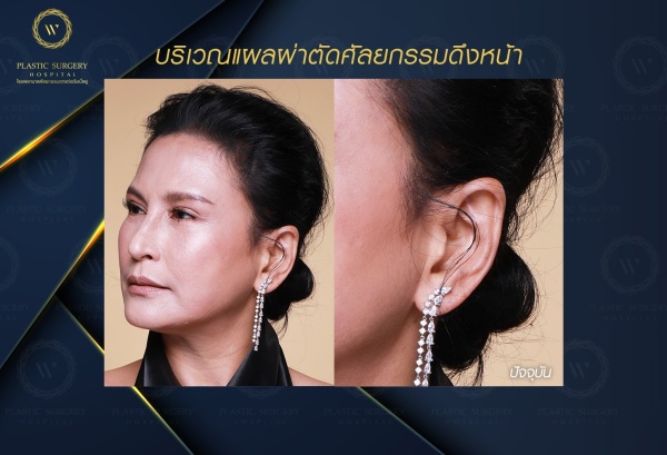 ดึงหน้า