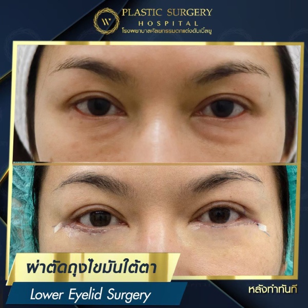 ตัดถุงไขมันใต้ตา