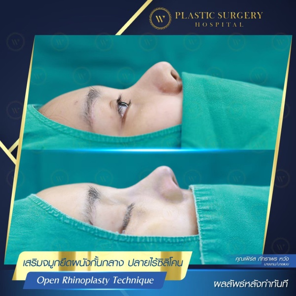 เสริมจมูก