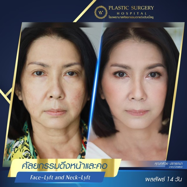 ดึงหน้า