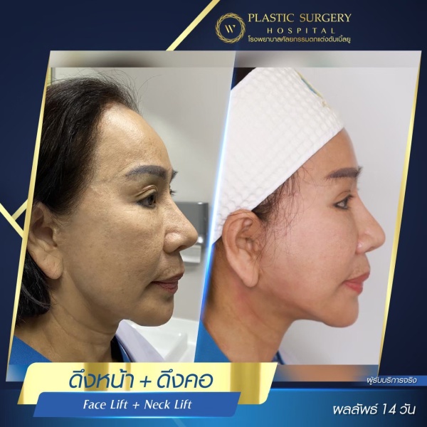 ดึงหน้า