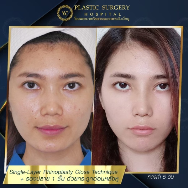 เสริมจมูก