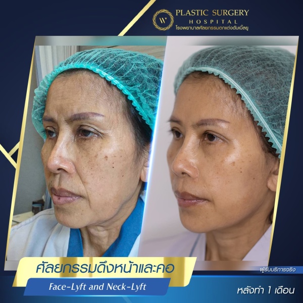 ดึงหน้า