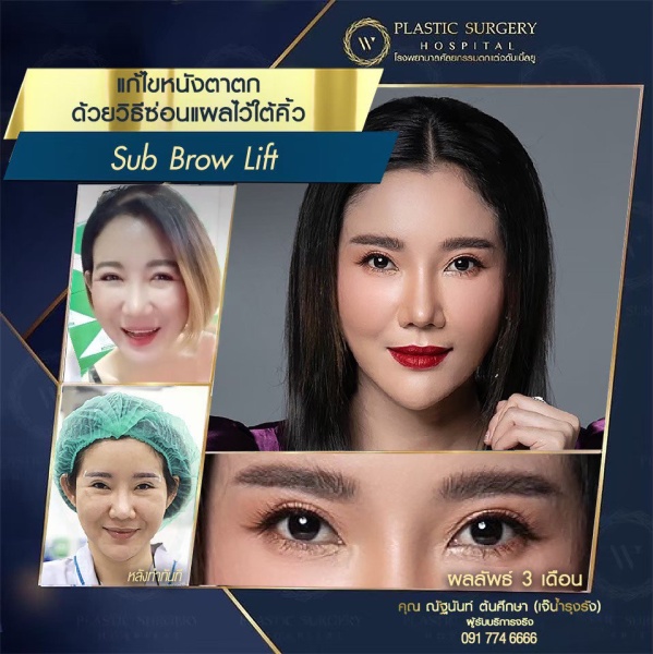 หนังตา/หางตาบนตก