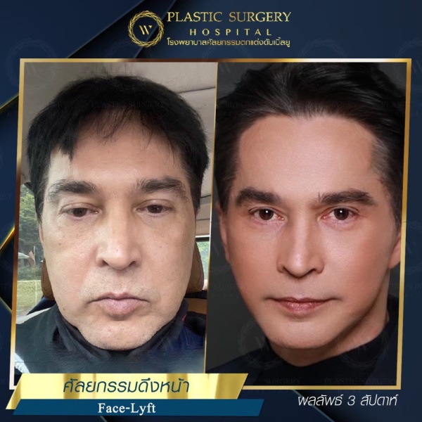 ดึงหน้า