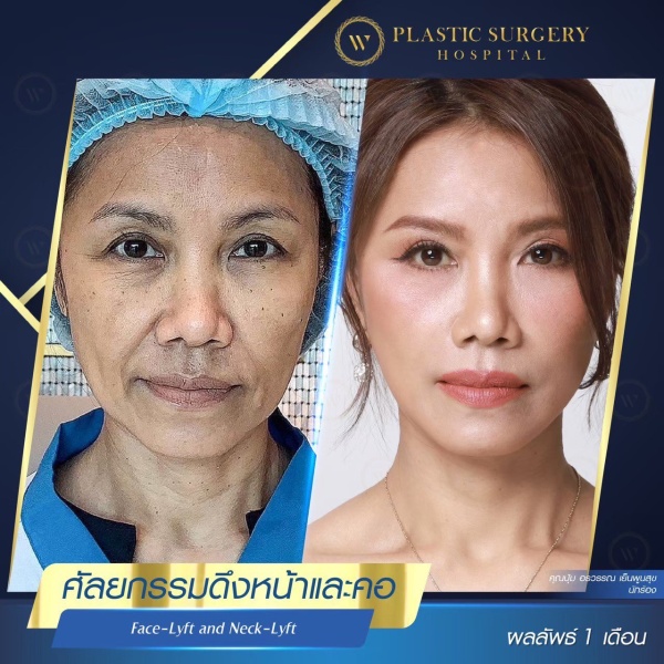 ดึงหน้า