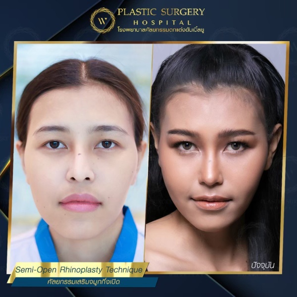 เสริมจมูก