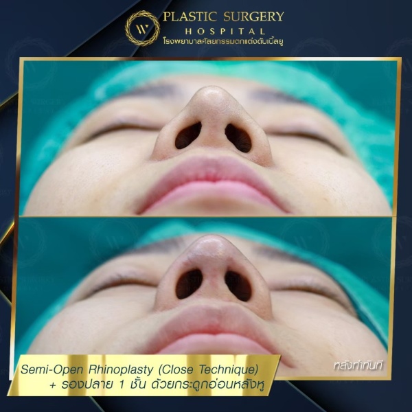 เสริมจมูก