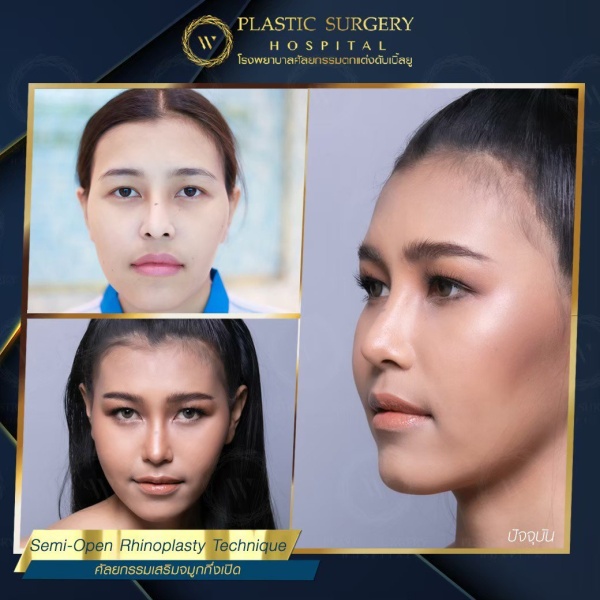 เสริมจมูก