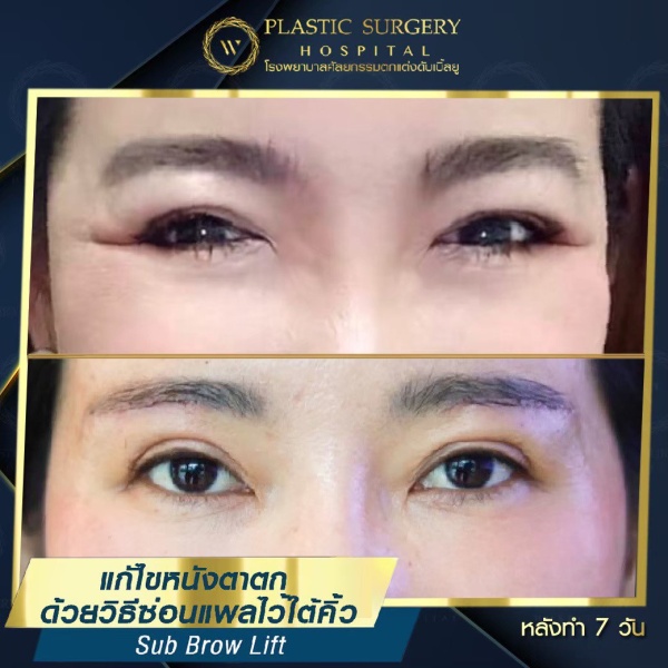 หนังตา/หางตาบนตก