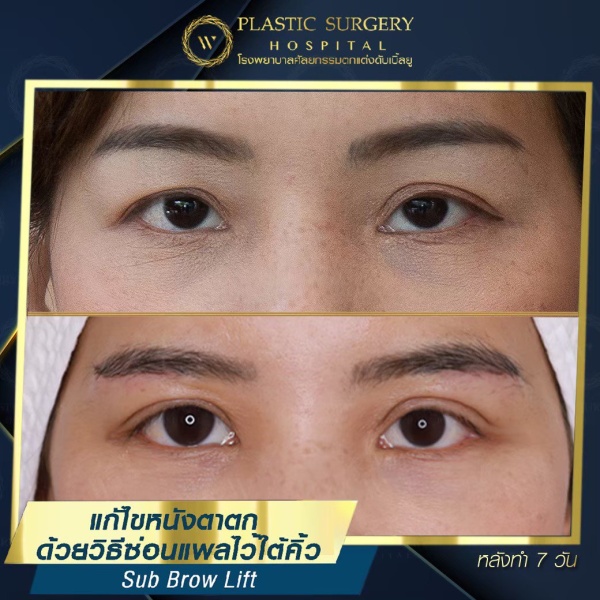 หนังตา/หางตาบนตก