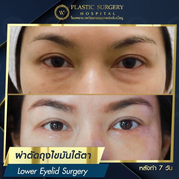 ตัดถุงไขมันใต้ตา