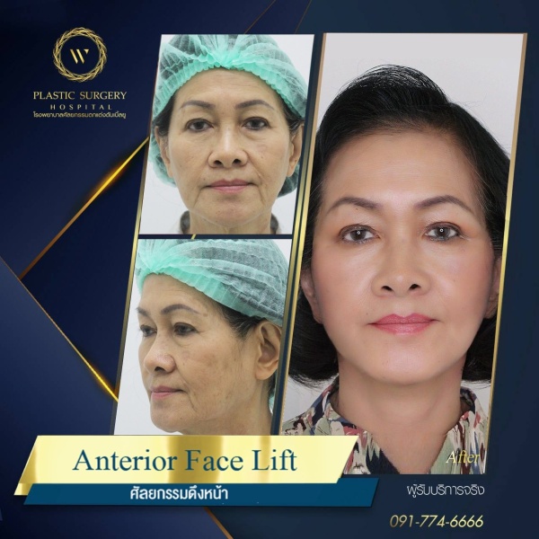 ดึงหน้า