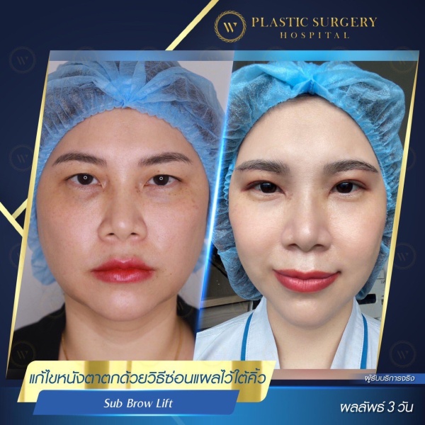 ศัลยกรรมแก้ไขปัญหาหนังตา