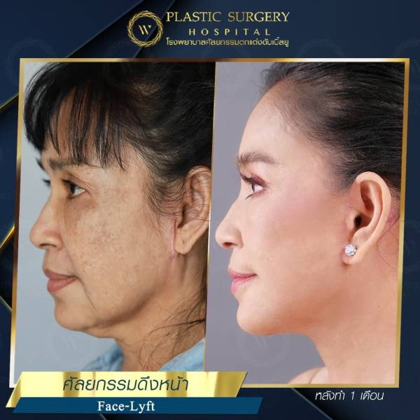 ดึงหน้า