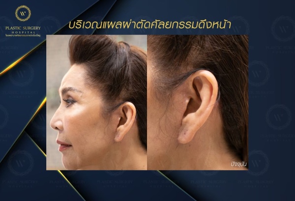 ดึงหน้า