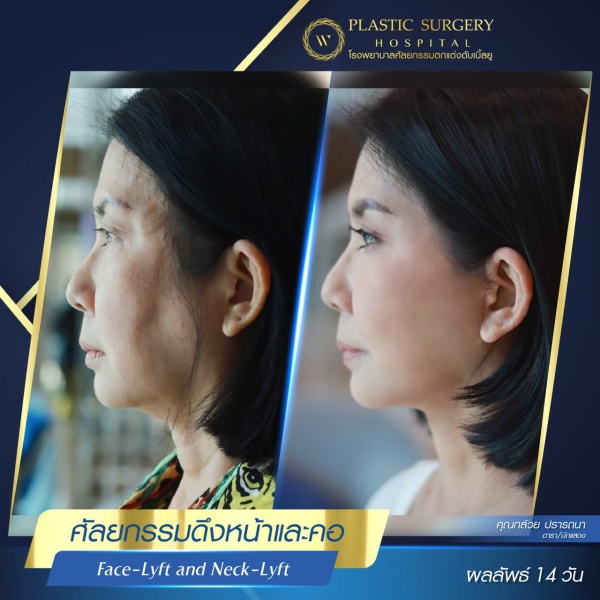 ดึงหน้า