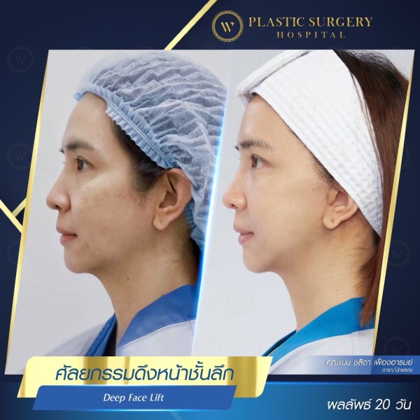 ดึงหน้า