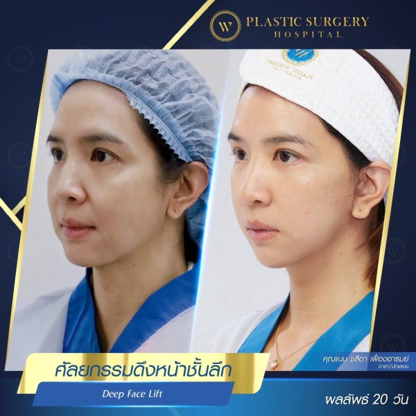 ดึงหน้า