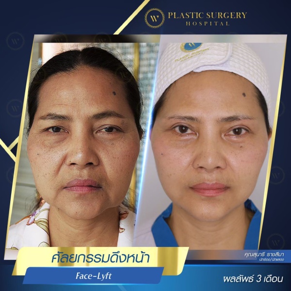 ดึงหน้า