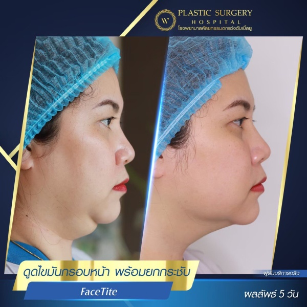 脸部和颈部的提升和抽脂