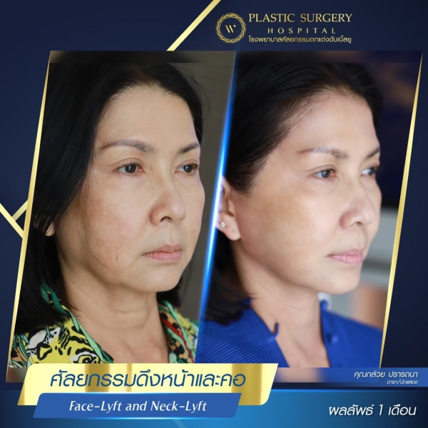 ดึงหน้า