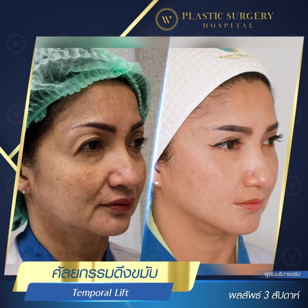 ดึงหน้า