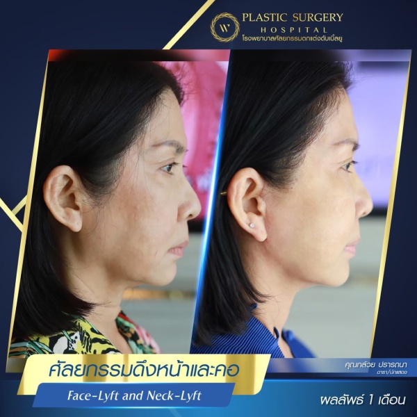 ดึงหน้า