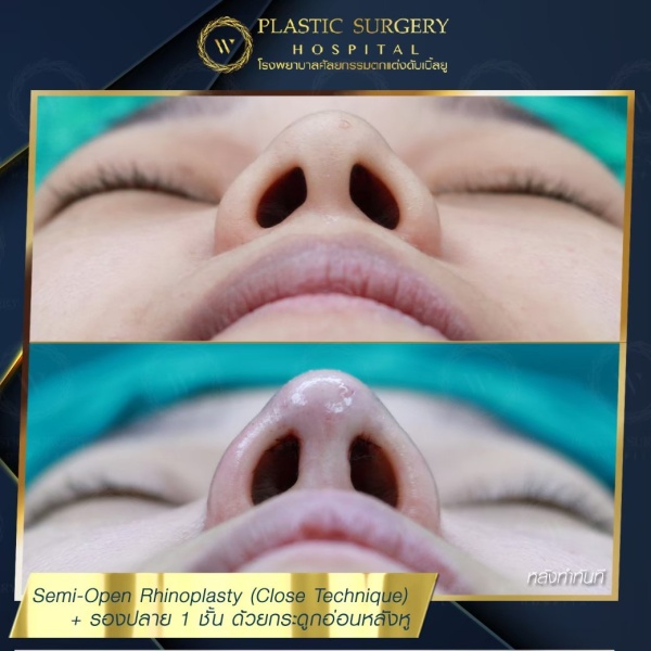 เสริมจมูก