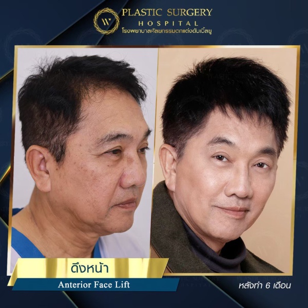 ดึงหน้า