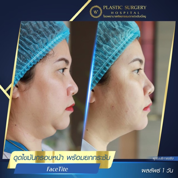 脸部和颈部的提升和抽脂