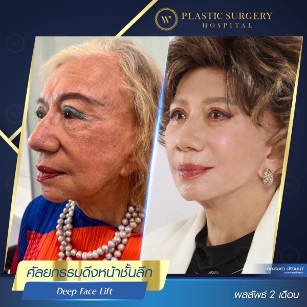 ดึงหน้า