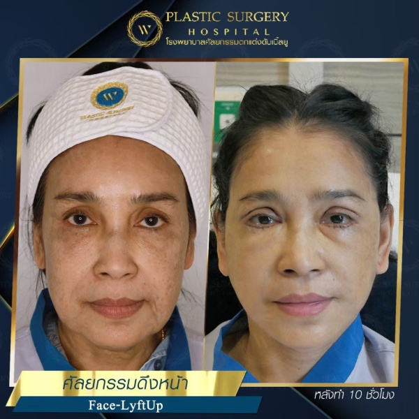 ดึงหน้า