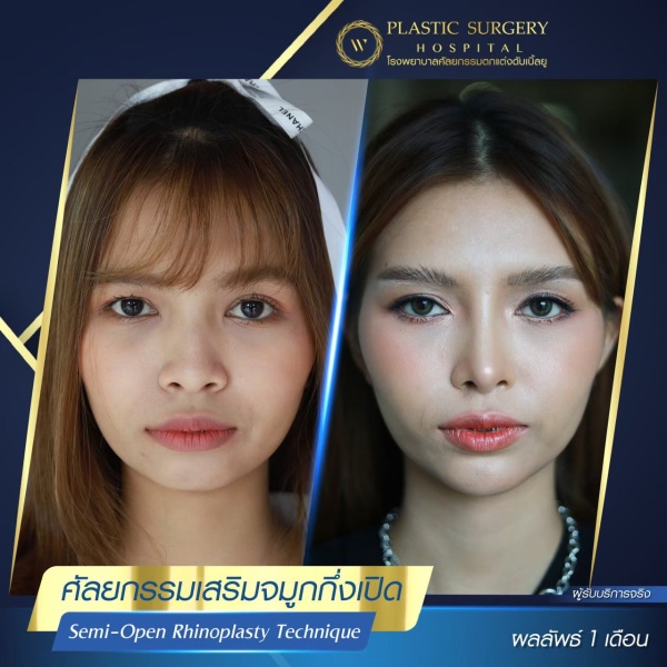 เสริมจมูก