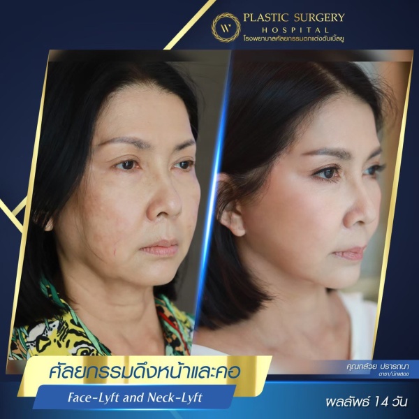 ดึงหน้า