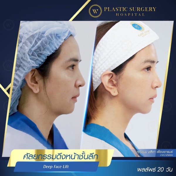 ดึงหน้า