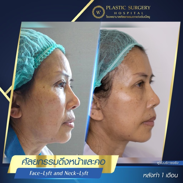 ดึงหน้า