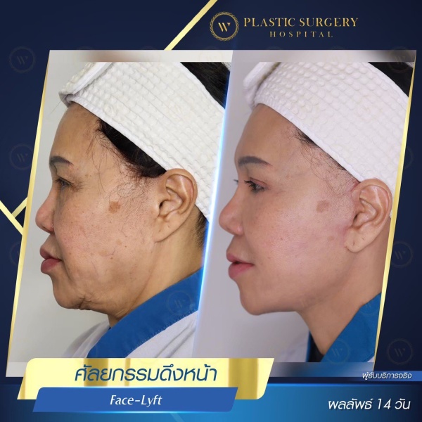 ดึงหน้า