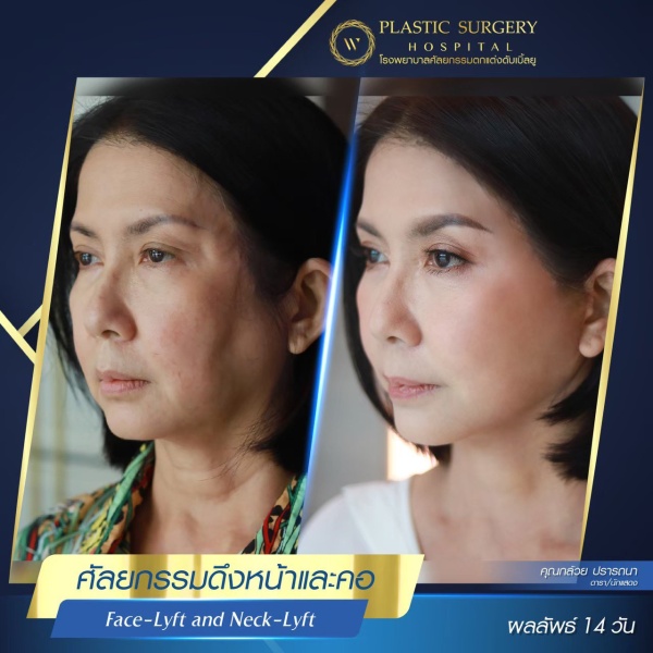 ดึงหน้า