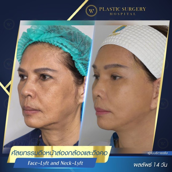 ดึงหน้า