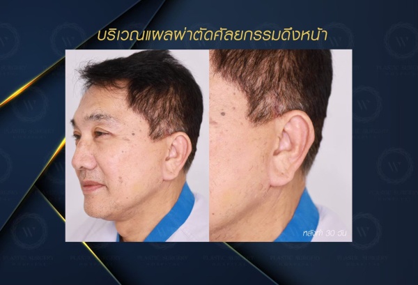 ดึงหน้า