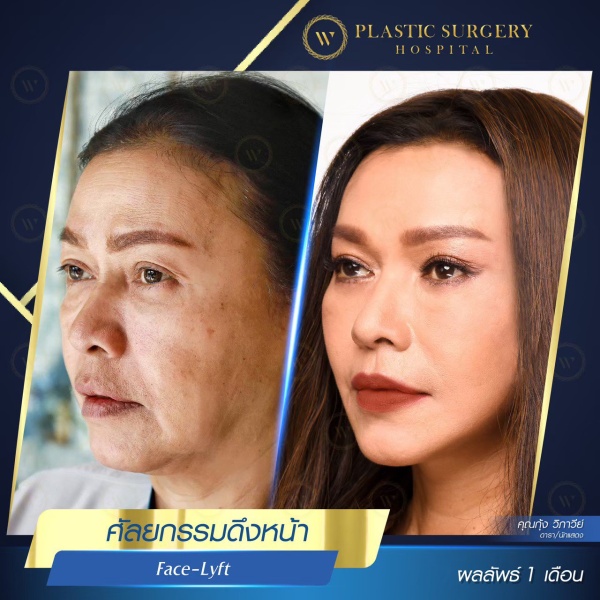 ดึงหน้า