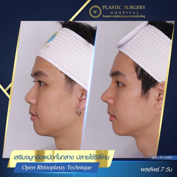 เสริมจมูก